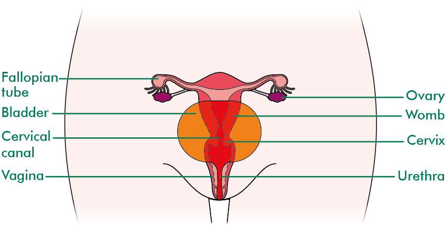 What Is A Hysterectomy Information And Support
