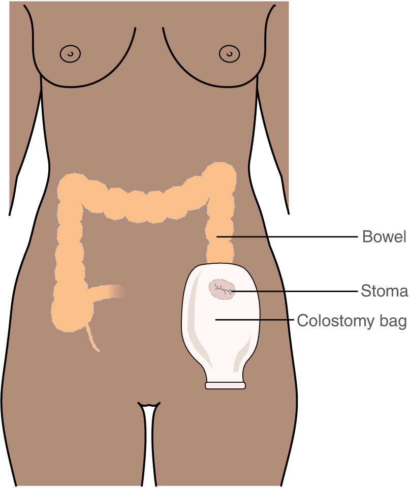 colostomy bag on a person