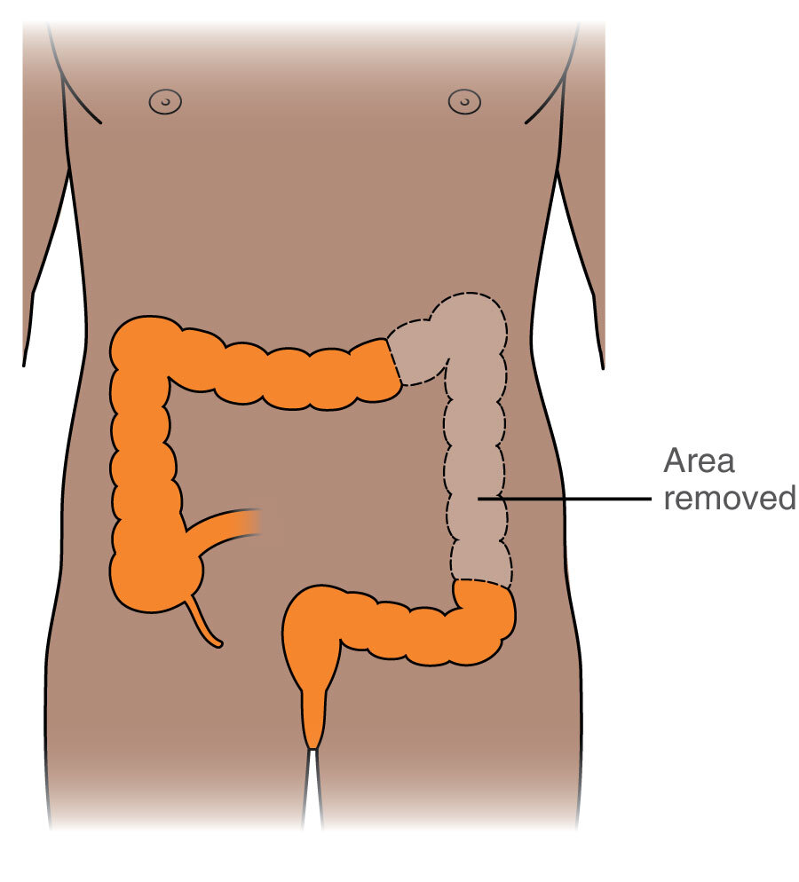 Surgery For Colon Cancer Macmillan Cancer Support