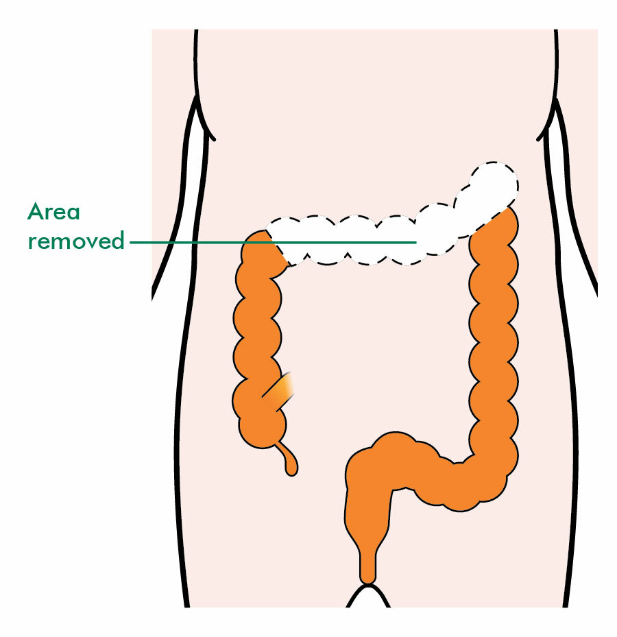 surgery-to-remove-colon-cancer-macmillan-cancer-support