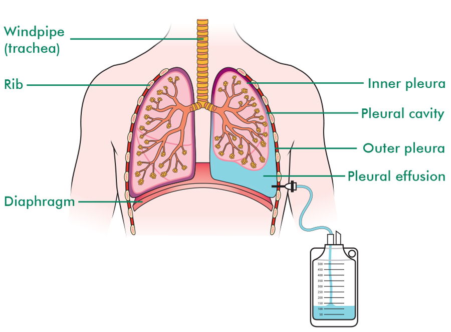 Pleural effusion Macmillan Cancer Support