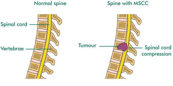 Malignant Spinal Cord Compression Mscc Macmillan Cancer Support