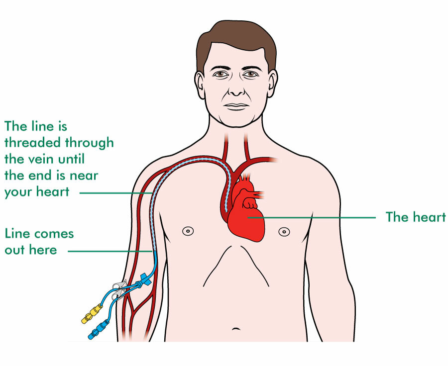 Left Arm Picc Line - Goimages Domain