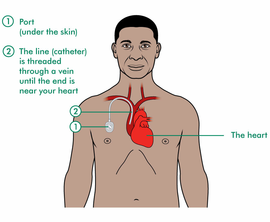 implanted port