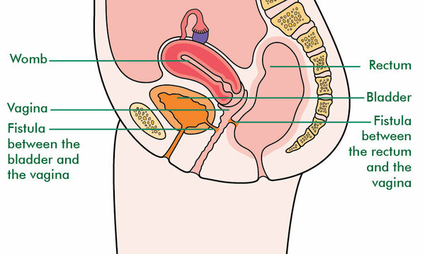 What Is A Fistula Signs And Symptoms Macmillan Cancer Support