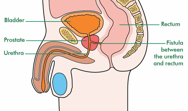 What Is A Fistula Signs And Symptoms Macmillan Cancer Support