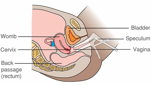 Endometrial biopsy Information