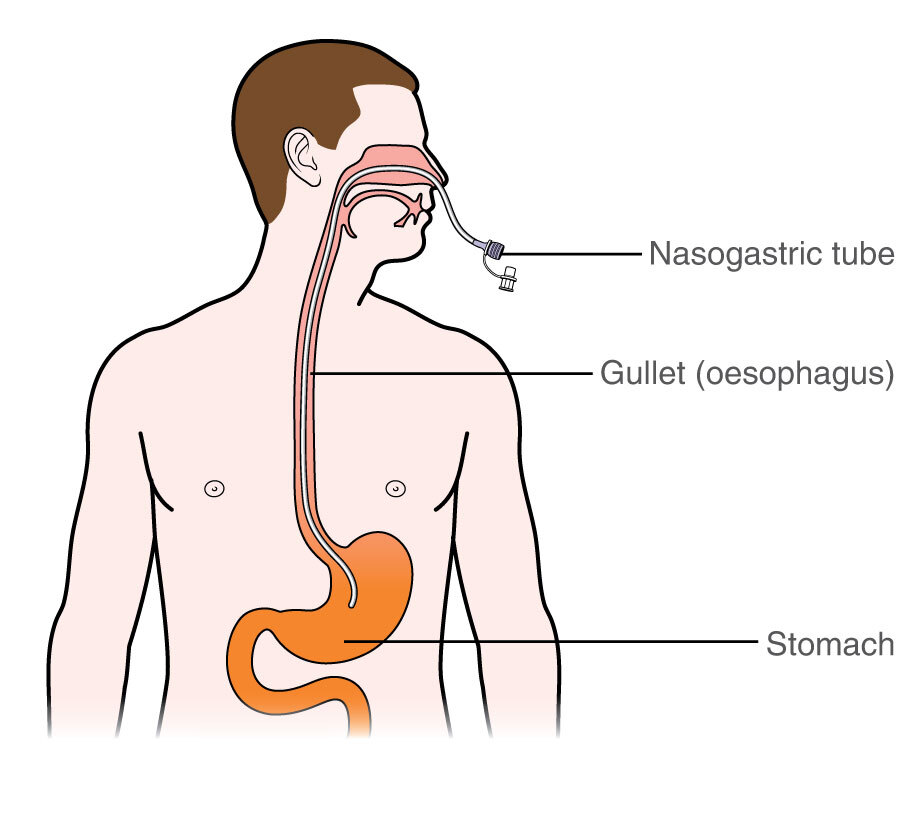 Stomach Tube