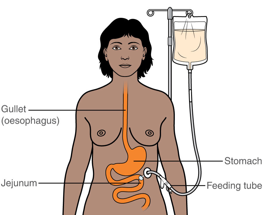 gastric feeding tube