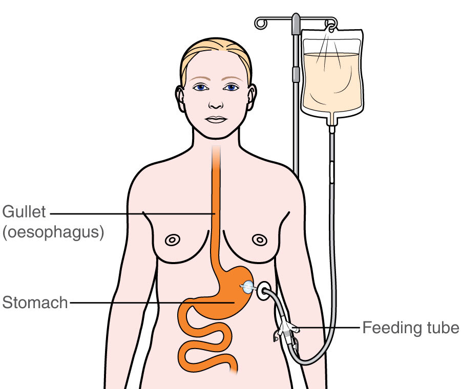 gastric feeding tube