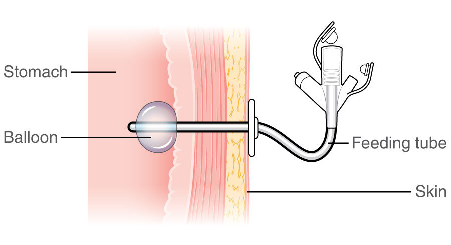 gastric feeding tube