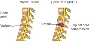 Spinal cord compression: what it means and how it can be treated