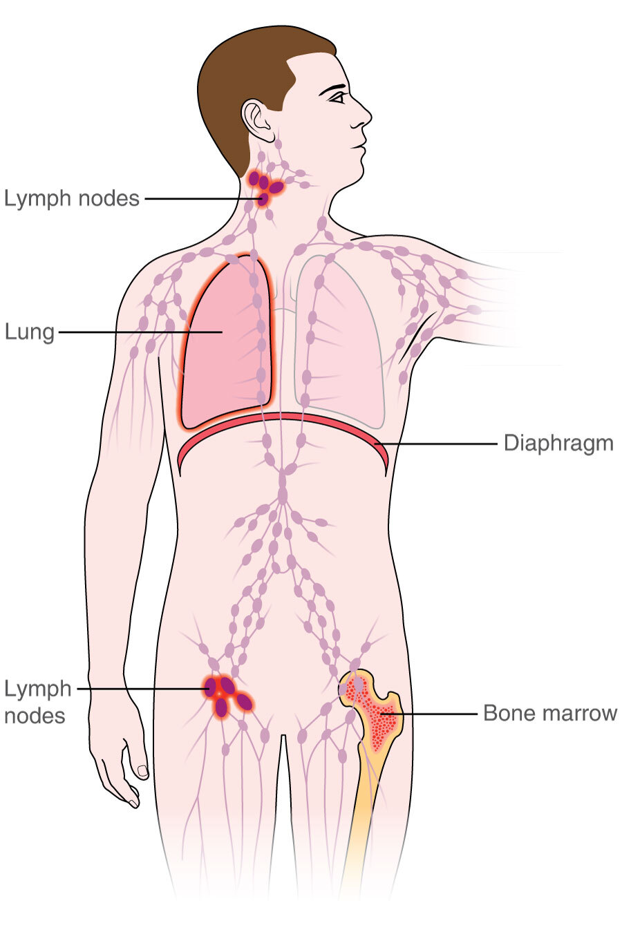 Lymphoma Symptoms Causes And Treatments 52 Off 