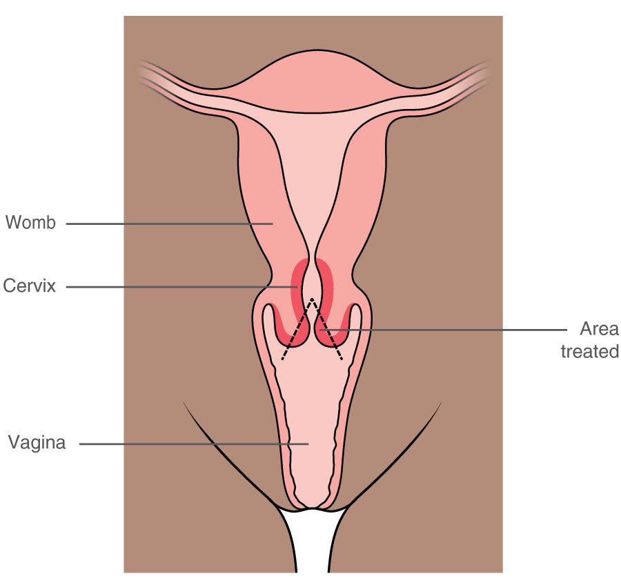 Treatment for abnormal cervical cells Macmillan Cancer Support