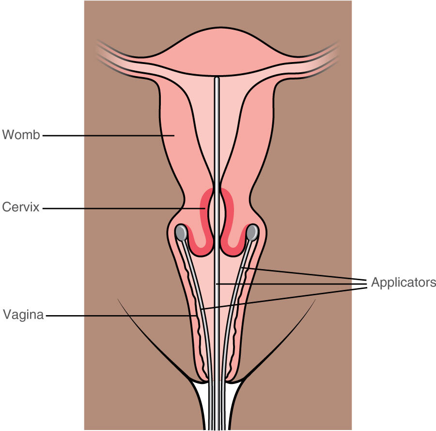 Radiotherapy for cervical cancer