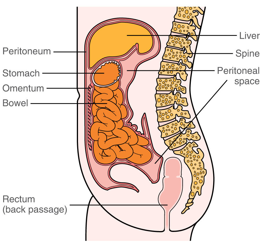 Adhesions after abdominal surgery