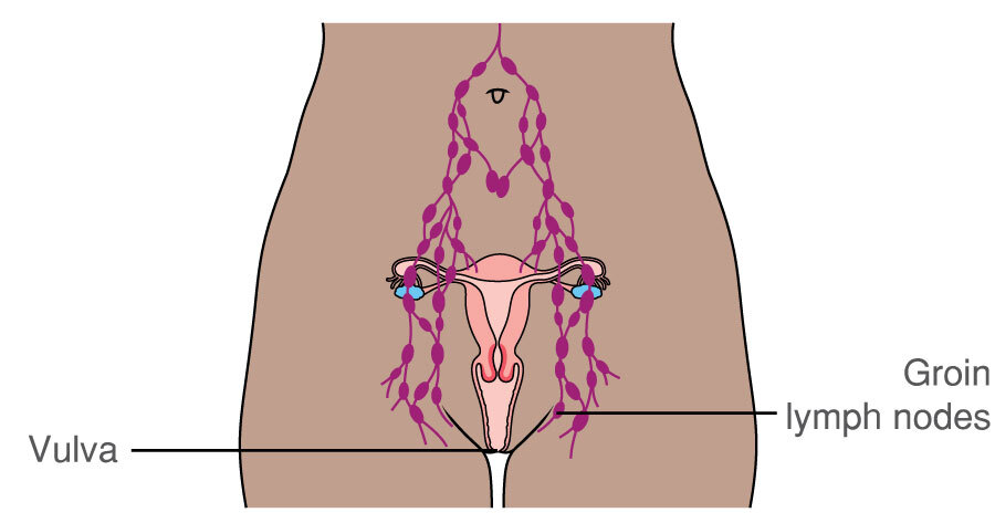 The vulva - vulval cancer and lymph nodes in the groin