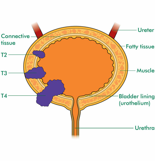 Staging and grading of bladder cancer - Macmillan Cancer Support