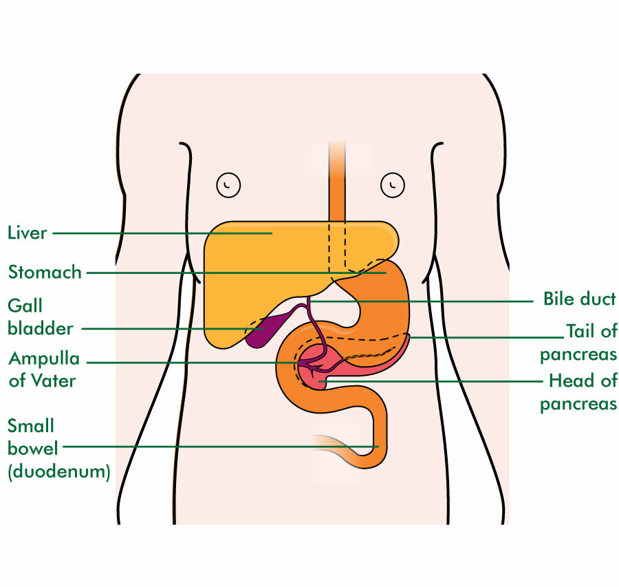 Bile Duct Cancer Staging Treatment And Surgery Dr Nikhil Agrawal