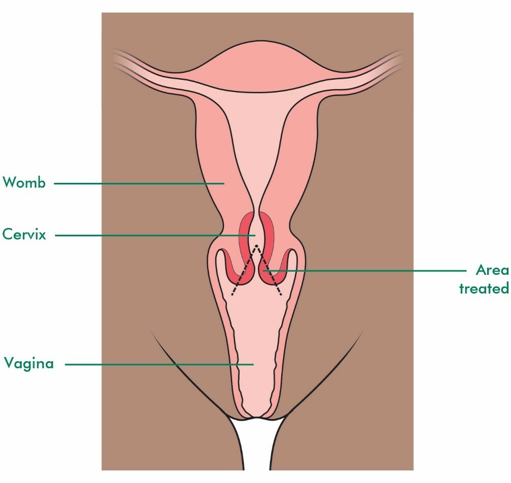 Featured image of post How to Make Punch Biopsy Cervix Side Effects