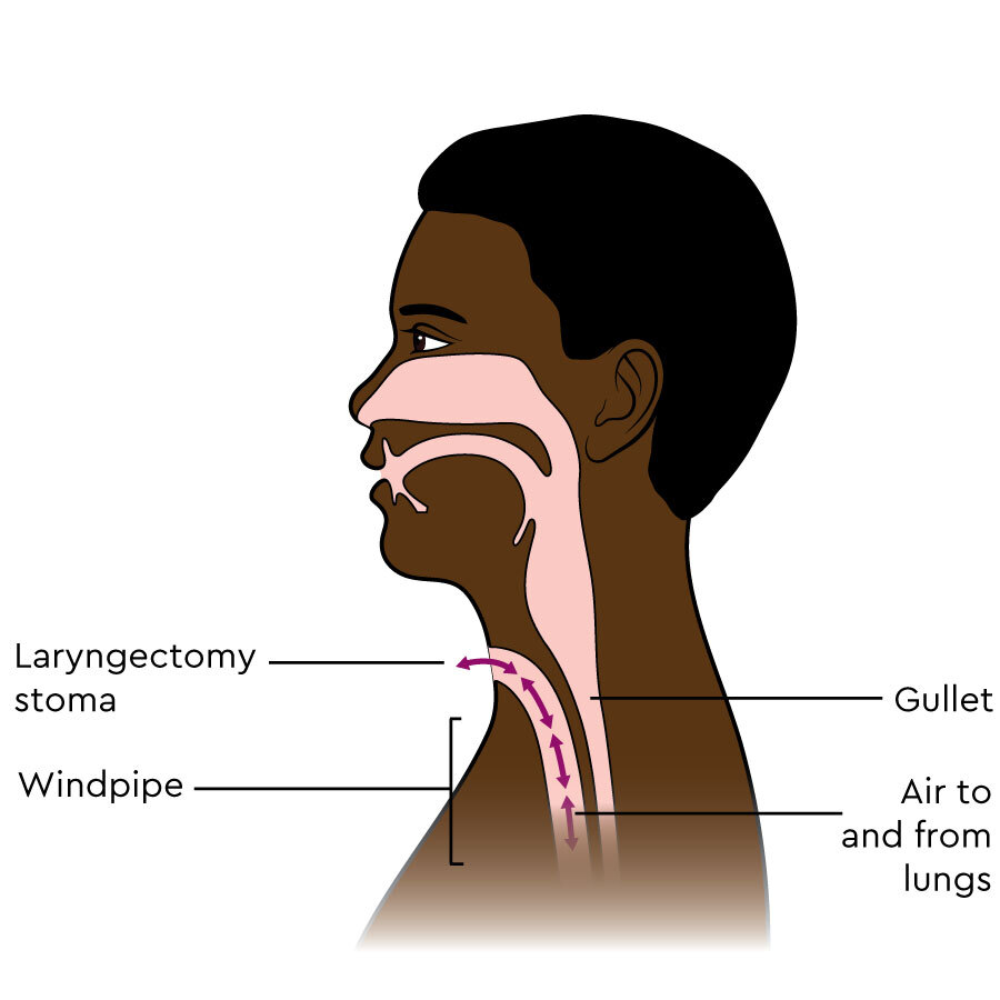 laryngectomy anatomy