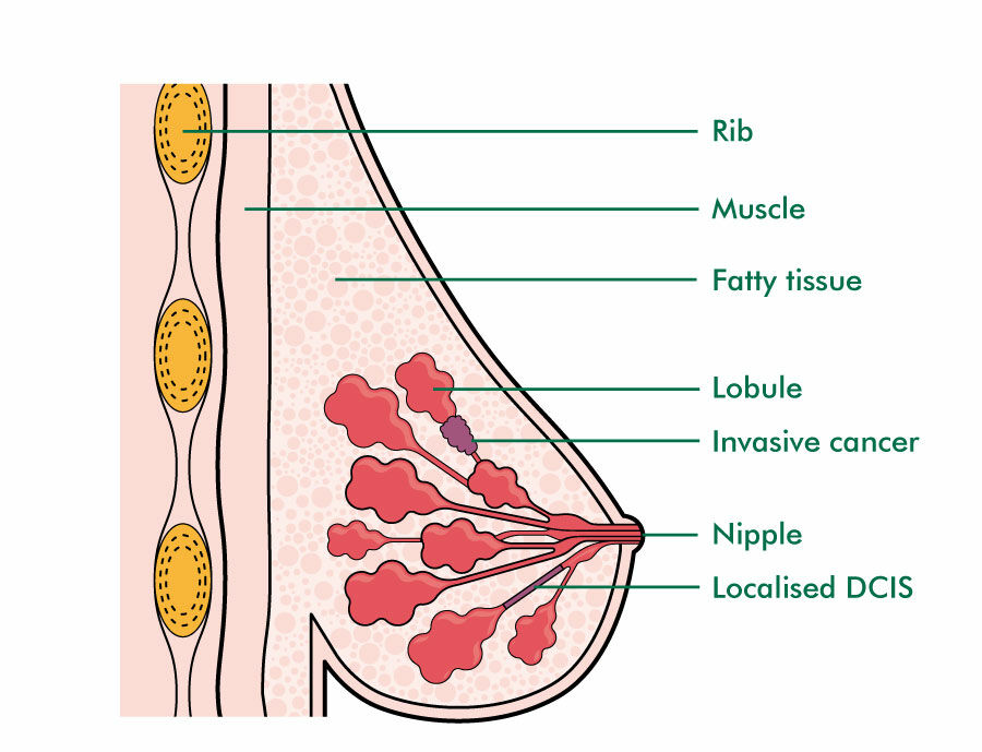 Paget's disease of the nipple - NHS