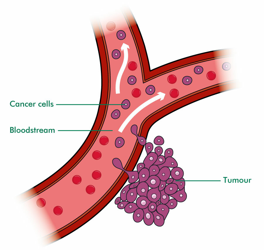 Radiation for liver cancer: How it works, side effects, success rate