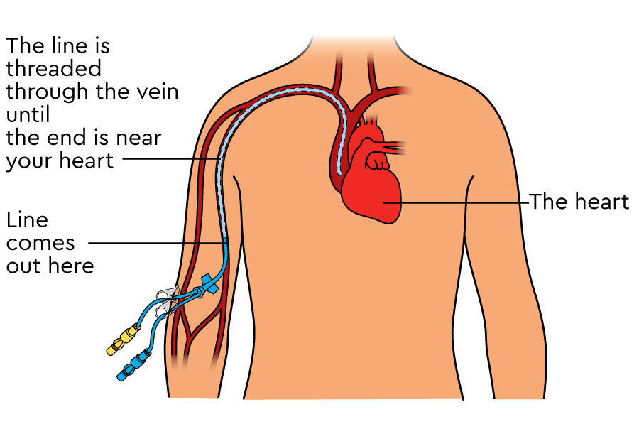 Central lines for chemotherapy and other drugs